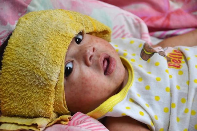 Como Saber Se O Bebe Esta Com Sarampo E Qual O Tratamento Tua Saude Como Saber Se O Bebe Esta Com Sarampo E Qual O Tratamento Tua Saude