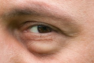 Ojos y párpados hinchados: 8 causas y qué hacer