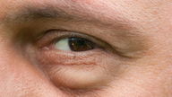 Ojos y párpados hinchados: 8 causas y qué hacer