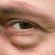 Olhos inchados: 8 principais causas e o que fazer