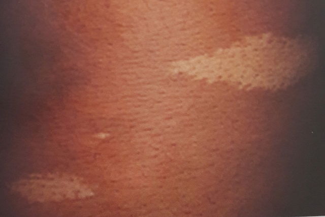 What Are the White Spots on My Skin?