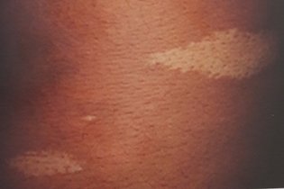 White Spots On Skin: 9 Causes & What They Mean