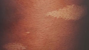White Spots On Skin: 9 Causes & How To Get Rid of Them