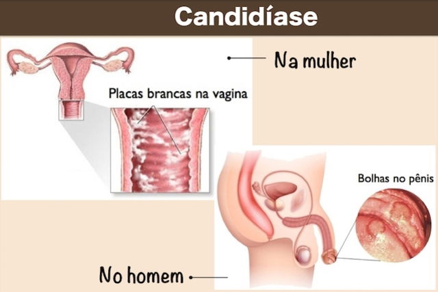 Sintomas de candidíase (genital, na garganta, na pele e intestinal) - Tua  Saúde