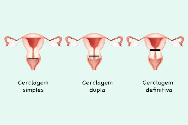 Cerclagem Uterina O Que E Como Feita A Cirurgia Para Segurar O