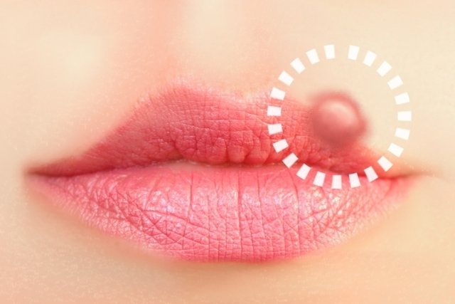 7 doenças transmitidas pelo beijo