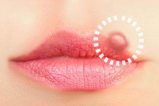 Herpes labial