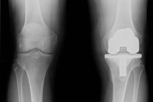 Imagen ilustrativa del artículo Cómo es la cirugía para colocar una prótesis de rodilla (artroplastia)
