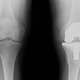 Cómo es la cirugía para colocar una prótesis de rodilla (artroplastia)