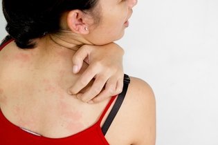 Alergia en la piel: síntomas, causas y medicamentos