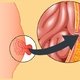 Hernia: What it Is, Symptoms, Types, & Treatment