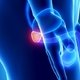 Cirurgia de próstata (prostatectomia): o que é, tipos e recuperação
