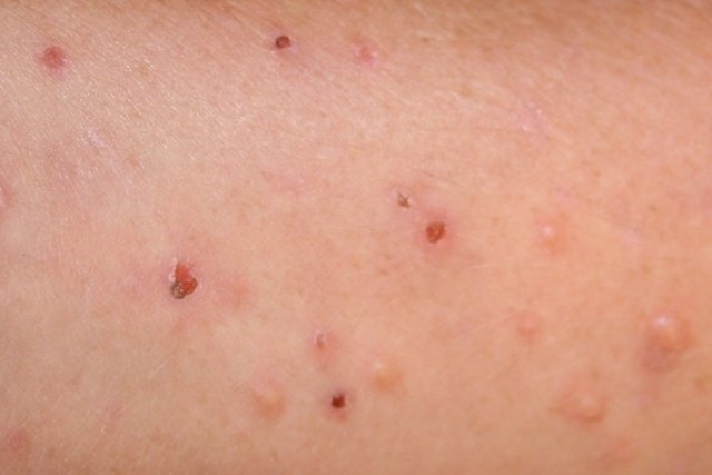 Dermatitis por alergia