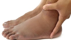 Mala circulación en pies y piernas: principales síntomas y tratamiento