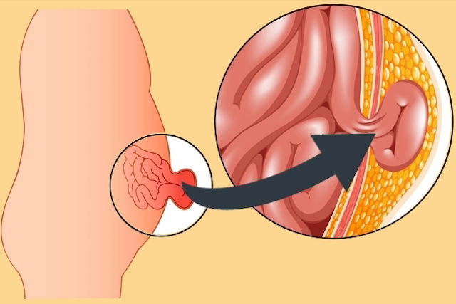 Hérnia abdominal - causas, sintomas, tratamento, cirurgia