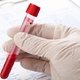 ALT Blood Test: What Is It & Normal Range