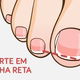 Porque a unha encrava (e como evitar)