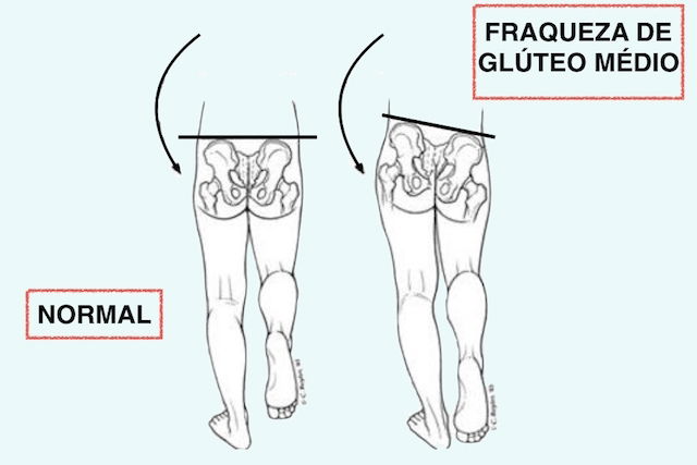 Fraqueza Do Glúteo Médio Causa Dor No Quadril - Veja Como Tratar - Tua ...