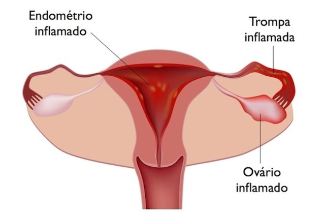 Salpingite: o que é, sintomas, causas e diagnóstico - Tua Saúde