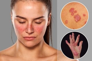 15 principais sintomas de lúpus (com teste online)