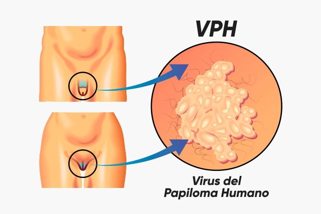 Papiloma Humano:  sÃ­ntomas, transmisiÃ³n y tratamiento