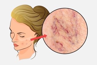 Imagem ilustrativa do artigo O que causa vasinhos no rosto (e como tratar)