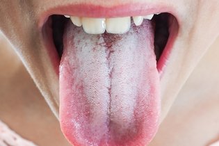 Illustrative image of the article White Tongue: 6 Causes & How to Get Rid of It