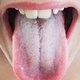 White Tongue: 6 Causes & How to Get Rid of It