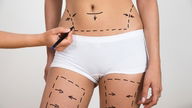 Quem pode fazer lipoaspiração?