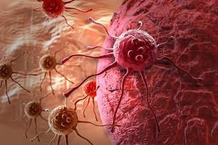 Imagen ilustrativa del artículo Síntomas de cáncer cervicouterino: etapa temprana y terminal