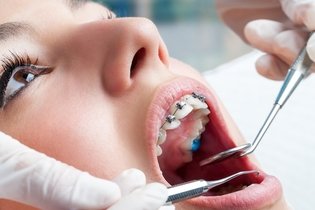 Imagem ilustrativa do artigo Má oclusão dentária: o que é, sintomas e tratamento