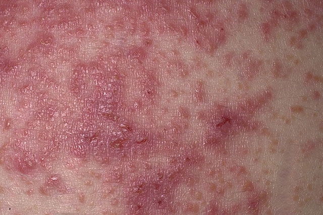 Eczema