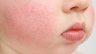 Manchas rojas en la piel del bebé: 7 causas y cómo tratar