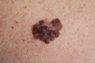 Imagen ilustrativa del artículo Manchas oscuras en la piel: 8 causas y qué hacer