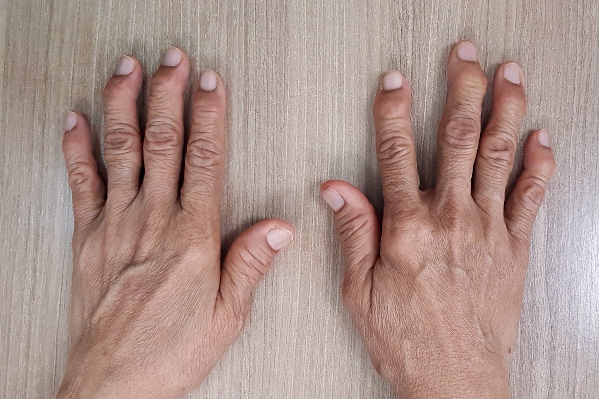Болят суставы пальцев рук к какому врачу. Ревматоидный артрит руки.