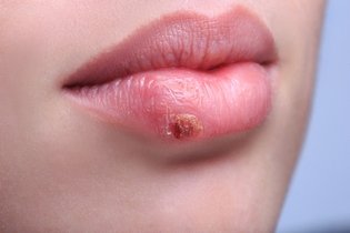 Como se pega herpes (labial, genital e zóster) e como se proteger