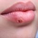 Como se pega herpes (labial, genital e zóster) e como se proteger
