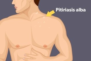 Imagen ilustrativa del artículo Pitiriasis alba: qué es, síntomas y tratamiento 