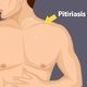 Pitiriasis alba: qué es, síntomas y tratamiento 