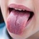 Manchas na língua: o que pode ser e o que fazer