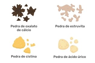 Imagem ilustrativa do artigo 4 tipos de pedra nos rins (alimentação e como eliminar)