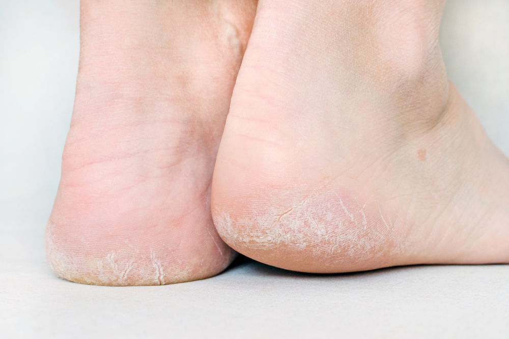 why-are-my-feet-peeling-causes-what-to-do-tua-sa-de