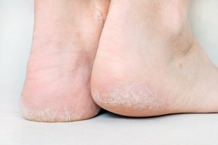 Why Are My Feet Peeling? Causes & What To Do
