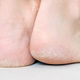 Why Are My Feet Peeling? Causes & What To Do