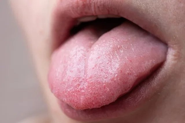 Dermapixel Un bulto en la lengua
