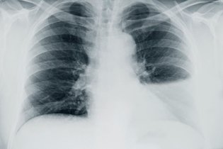 9 sintomas de água no pulmão e como confirmar
