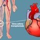 Qué es y cuáles son los riesgos del bypass coronario
