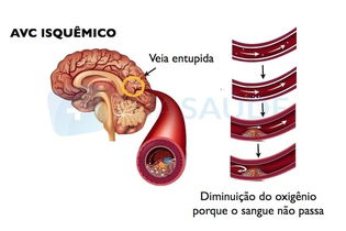 AVC Isquêmico