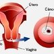Principais causas de câncer de colo de útero