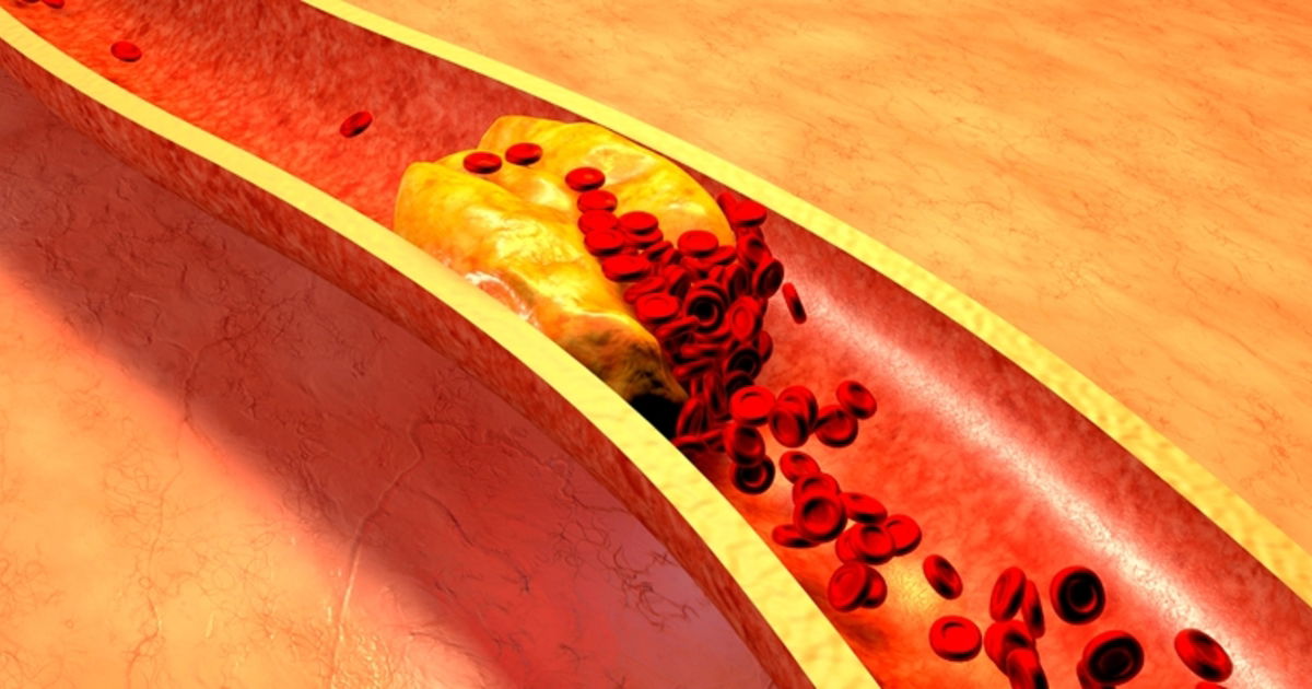 colesterol-ldl-por-que-ruim-e-como-baixar-tua-sa-de